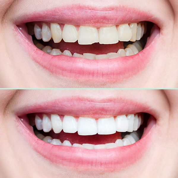Before and after dental bonding